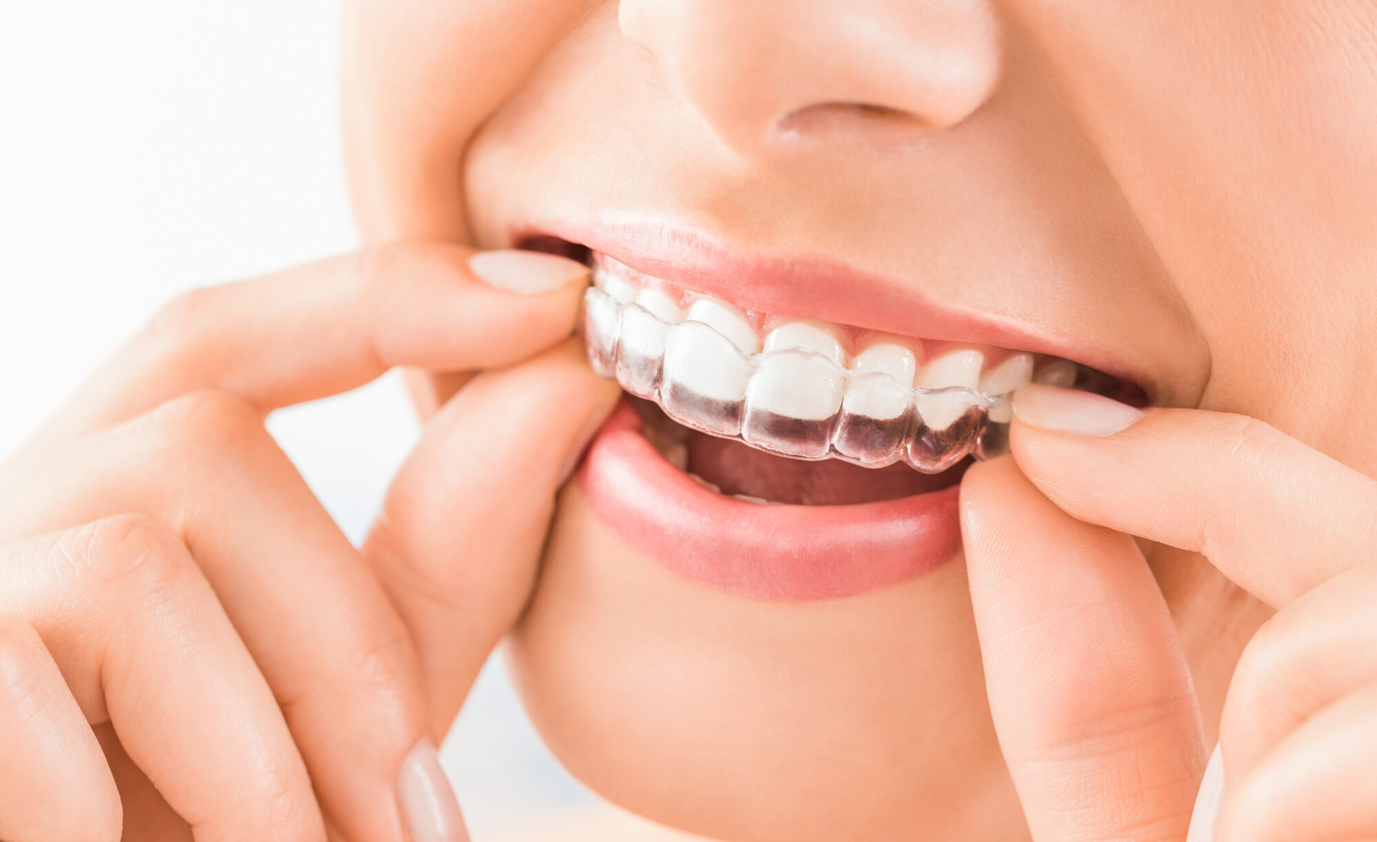 invisalign sedalia